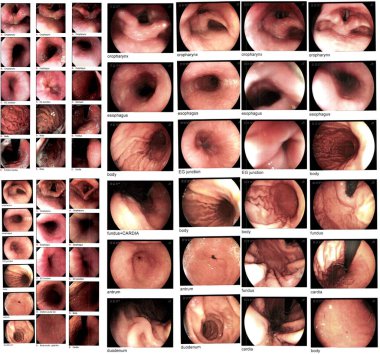 Koleksiyon Gastrointestinal endoskopik muayene görüntüsü kronik gastrit akut gösteriyor. Tıbbi sağlık konsepti. Tam çözelti göründüğünde sıklıkla ve bulanık.