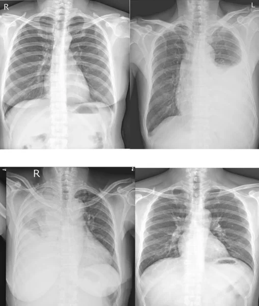 Radiografía Tórax Colección Para Médicos Profesionales Médicos Para Aprender Enfermedad — Foto de Stock