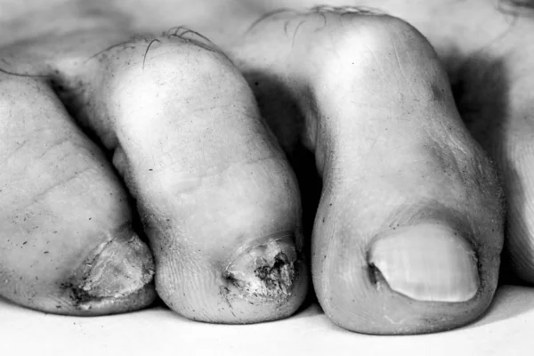 Fungus Infection Nails Male Feet — Stock Photo, Image