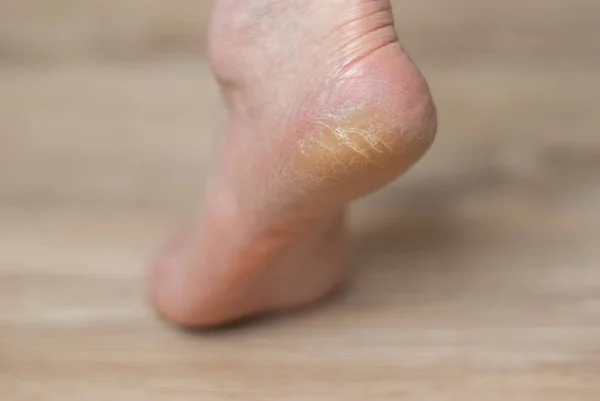 Clavus e crepe sul tallone del piede — Foto Stock