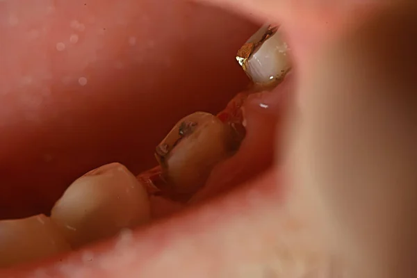 ピンの歯の修復 歯科マクロ 歯科治療 — ストック写真