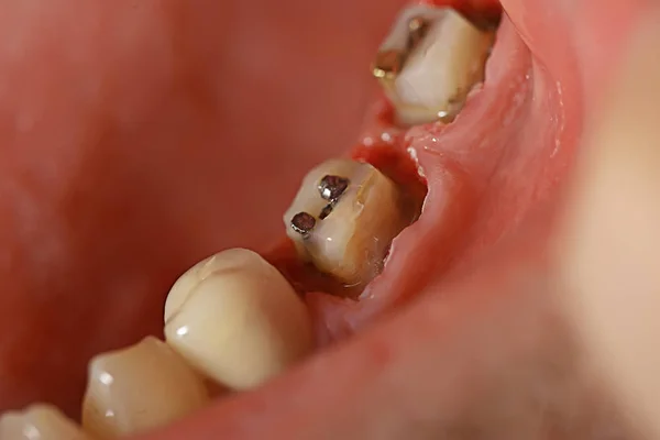 Restauro Dei Denti Sulla Macro Perno Odontoiatria Dente Gengiva Trattamento — Foto Stock
