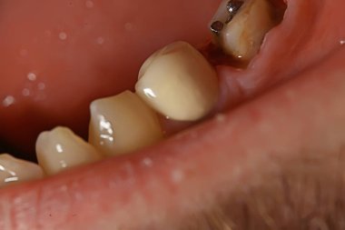 pin / diş hekimliği makro, diş, diş eti, diş tedavisi diş restorasyonu