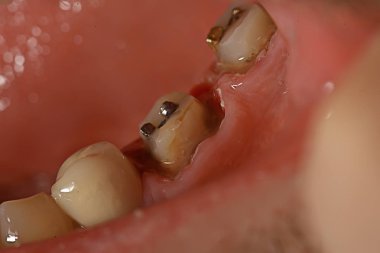 pin / diş hekimliği makro, diş, diş eti, diş tedavisi diş restorasyonu