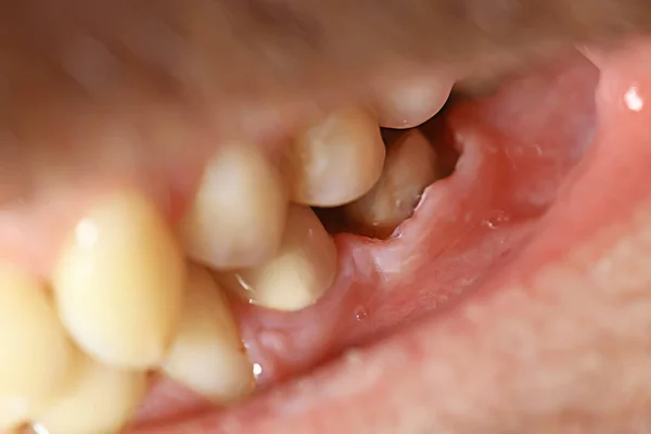 ピンの歯の修復 歯科マクロ 歯科治療 — ストック写真