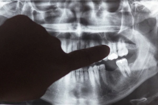 Рентгеновское Изображение Зубов Рта — стоковое фото