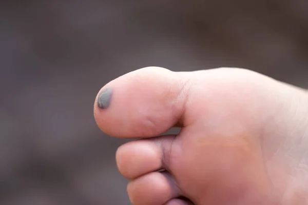 Bruise Big Toe — Stock Photo, Image