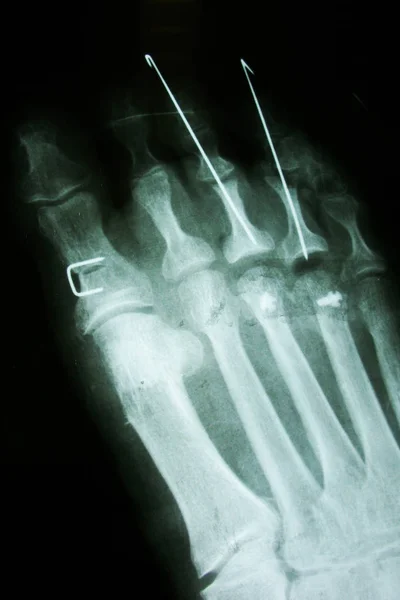 x ray , x-ray image photo of feet front view with a clove after fractur