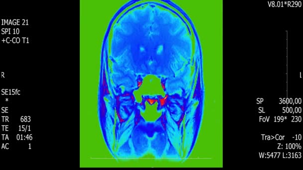 Verkliga livet man hjärnan mri scan med tumör neoplasm medical reseach ny kvalitet hälsa vetenskap 4k film lager animation skärm . — Stockvideo