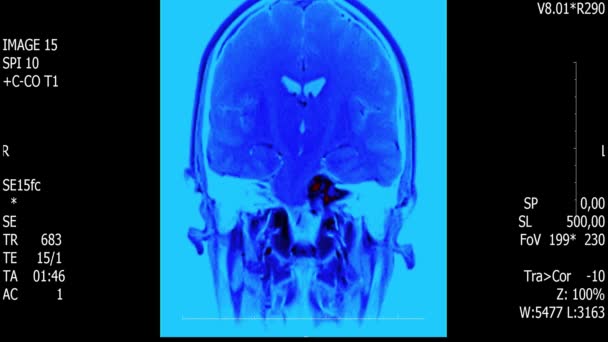 Prawdziwe życie człowieka mózg mri skanowania z guza nowotwór medycznych reseach nowe jakości zdrowia nauki 4k nagrania akcji animacji ekranu . — Wideo stockowe