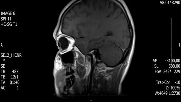 Prawdziwe życie człowieka mózg mri skanowania z guza nowotwór medycznych reseach nowe jakości zdrowia nauki 4k nagrania akcji animacji ekranu . — Wideo stockowe