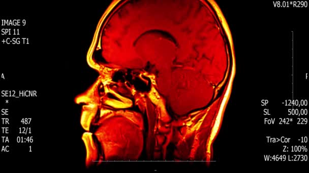 Exploración de la resonancia magnética del cerebro del hombre de la vida real con la investigación médica de la neoplasia tumoral nueva pantalla de animación del material de archivo de la ciencia de la salud de la calidad 4k  . — Vídeos de Stock