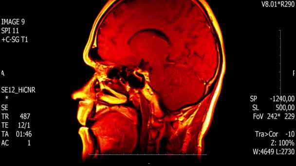 Verkliga livet man hjärnan mri scan med tumör neoplasm medical reseach ny kvalitet hälsa vetenskap 4k film lager animation skärm . — Stockvideo