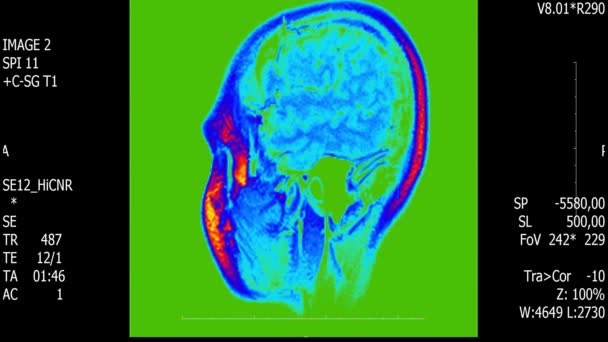 Prawdziwe życie człowieka mózg mri skanowania z guza nowotwór medycznych reseach nowe jakości zdrowia nauki 4k nagrania akcji animacji ekranu . — Wideo stockowe