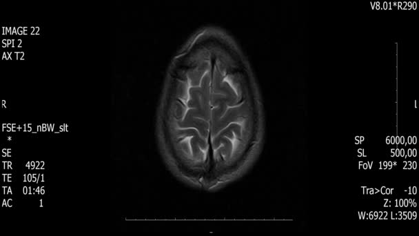 现实生活中的男性脑动扫描与肿瘤肿瘤医学研究新的优质健康科学4k 镜头股票动画屏幕 . — 图库视频影像