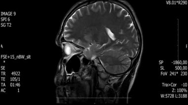 Gerçek hayatta adam beyin MRI tarama ile tümör neoplazma tıbbi araştırma yeni kalite sağlık bilim 4k görüntüleri stok animasyon perde .