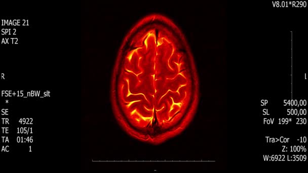 Prawdziwe życie człowieka mózg mri skanowania z guza nowotwór medycznych reseach nowe jakości zdrowia nauki 4k nagrania akcji animacji ekranu . — Wideo stockowe