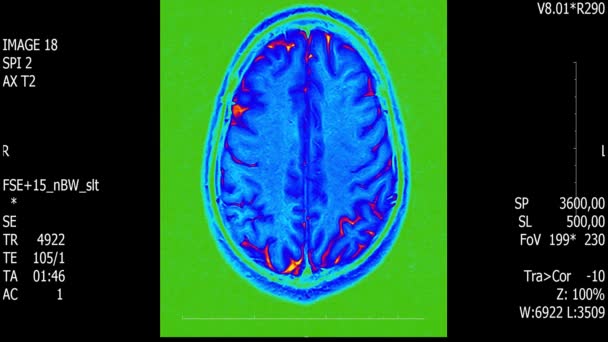 Prawdziwe życie człowieka mózg mri skanowania z guza nowotwór medycznych reseach nowe jakości zdrowia nauki 4k nagrania akcji animacji ekranu . — Wideo stockowe