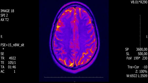 МРТ мозга человека реальной жизни с опухолевыми новообразования медицинское reseach новое качество здоровья науки 4k видео экрана анимации  . — стоковое видео