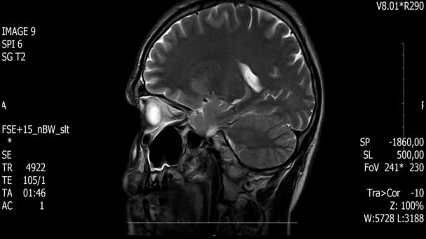 Exploración de la resonancia magnética del cerebro del hombre de la vida real con la investigación médica de la neoplasia tumoral nueva pantalla de animación del material de archivo de la ciencia de la salud de la calidad 4k  . — Vídeos de Stock