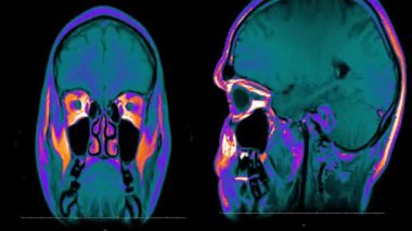 Gerçek hayatta adam beyin MRI tarama ile tümör neoplazma tıbbi araştırma yeni kalite sağlık bilim 4k görüntüleri stok animasyon perde .