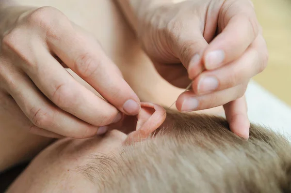 耳针治疗 女性的手在丈夫耳朵的穴位上使用针头 — 图库照片