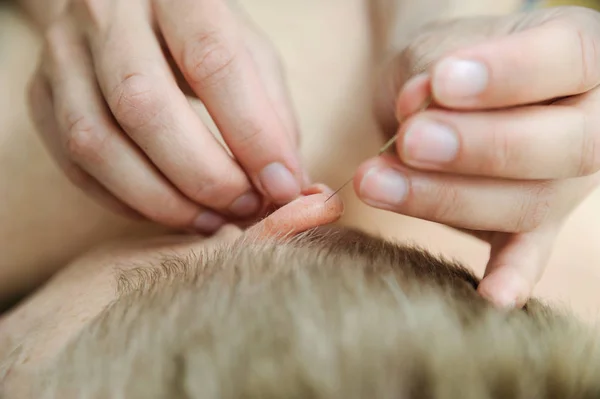 Ear Acupuncture Treatment Women Hands Applying Needles Acupuncture Points Husband — Stock Photo, Image
