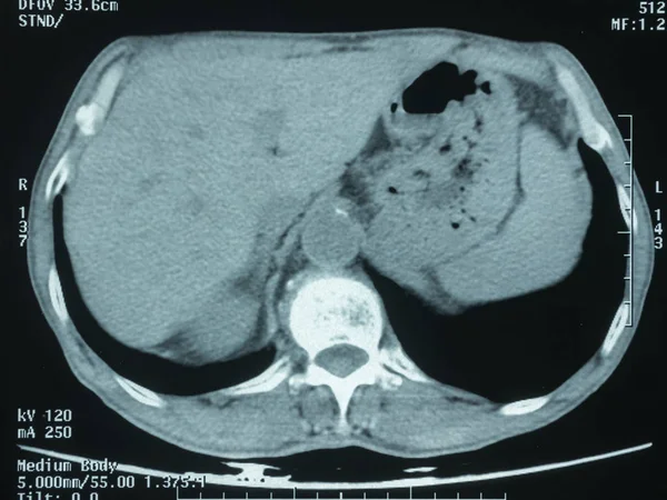Ταινία Ακτινογραφία Θώρακος Καρκίνο Του Πνεύμονα Από Ασθενή Που Αγαπούν — Φωτογραφία Αρχείου