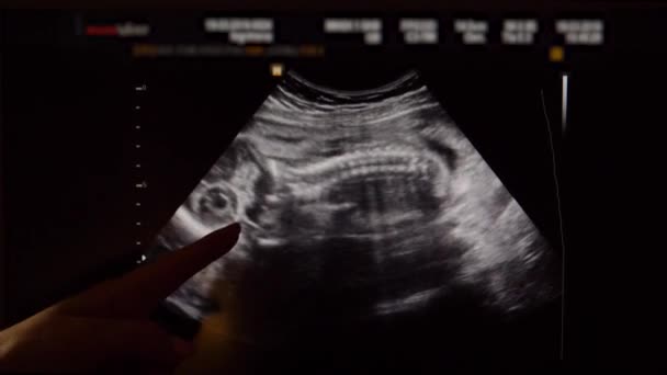 Ultraschall des Babys im Mutterleib im zweiten Trimester — Stockvideo