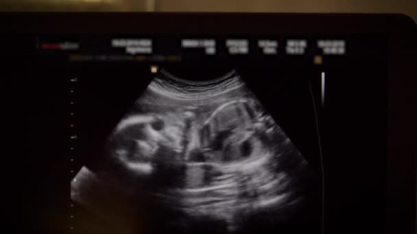 Na Monitor ultrazvuku dítěte v děloze v druhém trimestru — Stock video