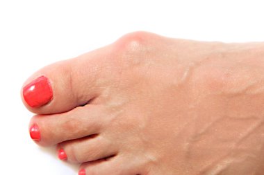 Varus valgus ve Hallux valgus veya orta yaşlı kadın da bunyon