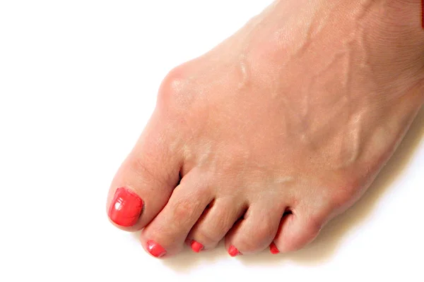 Varus valgus and Hallux valgus or bunion on middle aged woman — Stock Photo, Image