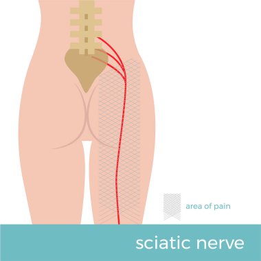 siyatik sinir anatomisi. sinir ve nerede ağrı ortaya çıkar yer şematik seyri gösteren çizim. siyatik 