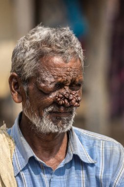 Belathur, Karnataka, India - November 1, 2013: Closeup of man with neurofibromatosis has face deformed with group of dark brown tumors on his nose. Blue shirt and gray hair. clipart