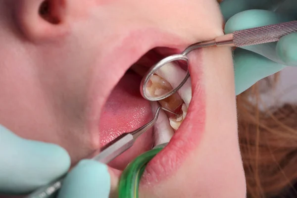 Zbliżenie Otwór Jamy Ząb Wierceniu Nadzieniem Dental Rolls Lustro — Zdjęcie stockowe