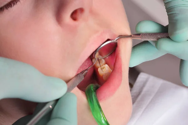 Detailní Záběr Díry Dutiny Zub Vrtání Náplní Dentální Nástroje Zrcadlo — Stock fotografie