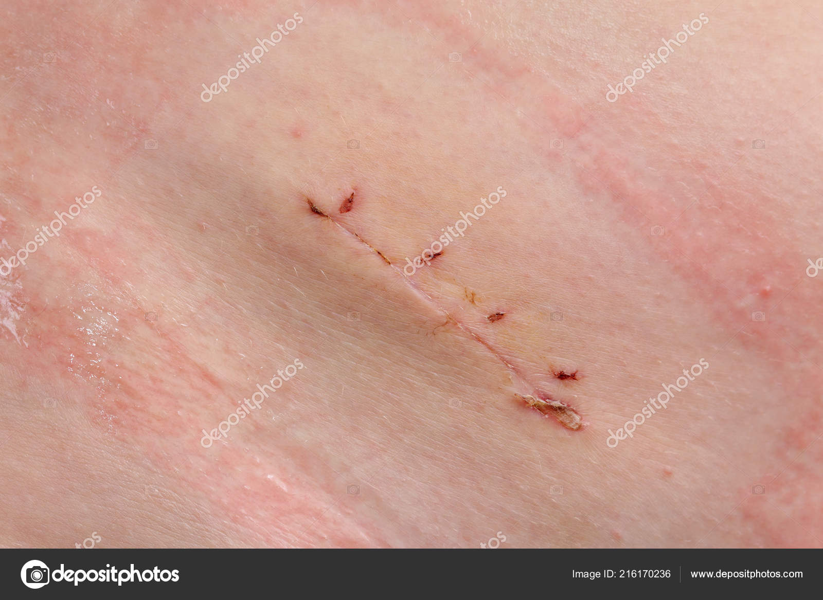 Closeup Fresh Appendix Surgery Scar Appendectomy Stock Photo by