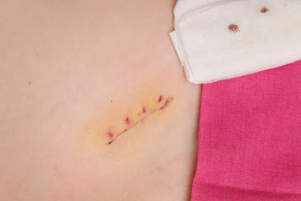 Primer Plano Cicatriz Cirugía Del Apéndice Fresco Apendicectomía —  Fotos de Stock