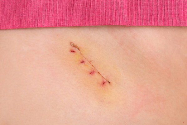 Closeup of fresh appendix surgery scar, appendectomy