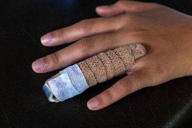 Alüminyum Parmak Ateli bir kadın yüzüğü parmağına parmak yaralanmaları tedavisi.