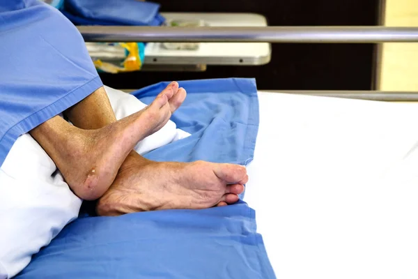 病床上瘫痪病人的脚 — 图库照片