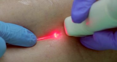 Doktor, ultrason sırasında lazer kullanarak sensörü dizin yüzeyine yönlendirir.