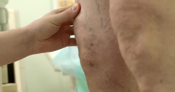 Detailní Záběr Lékař Zkoumá Křečové Žíly Nohou Staršího Muže — Stock video