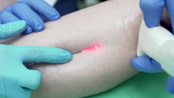 医者はレーザーを使用して超音波の間の膝の表面に沿ってセンサーを導く — ストック動画
