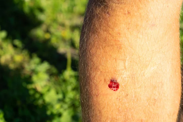 Bruised Wound Injury Man Knee Background Copy Paste — Stock Photo, Image