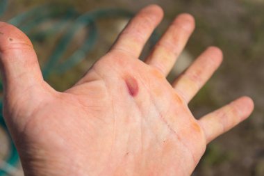 Blister palm, dikkatsiz çalışma, iyi değil Emanet ortasında