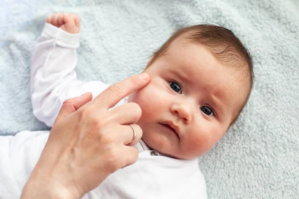 Μωρό Ατοπική Δερματίτιδα Πάρει Κρέμα Τεθεί Φροντίδα Και Πρόληψη Του — Φωτογραφία Αρχείου