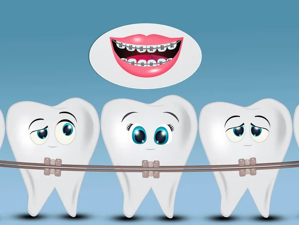 Kieferorthopädie Zähne Oder Zahnspangen — Stockfoto