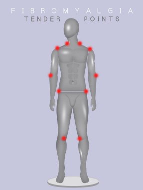 fybromialgia ihale nokta gösterimi