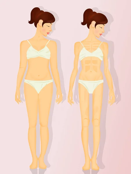 Illustrazione Anoressia Bulimia — Foto Stock